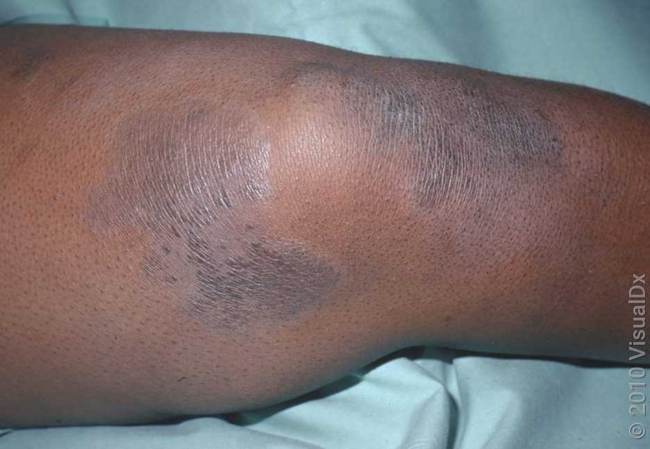 eczema dermatology-services-nairobi