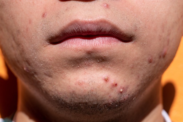 Acne dermatology