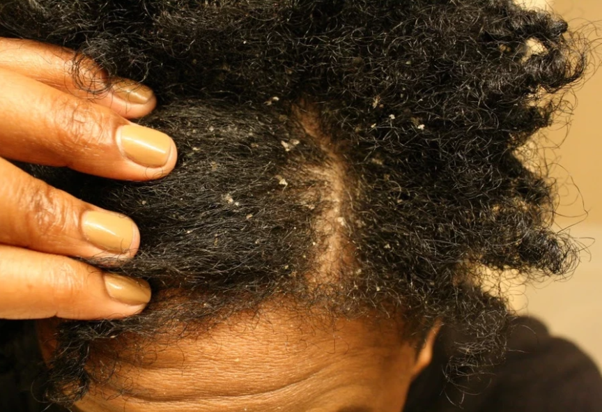 dandruff dermatology