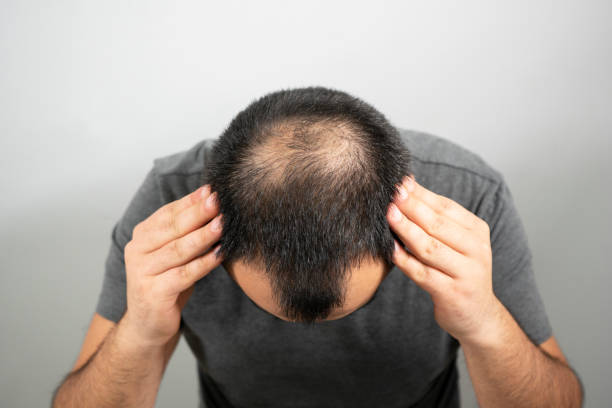 Hair loss dermatology