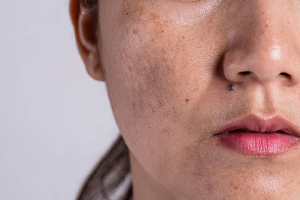 Pigmentation dermatology
