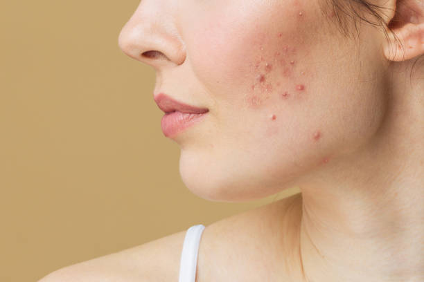 Understanding acne: Causes, Treatments, and Prevention.
